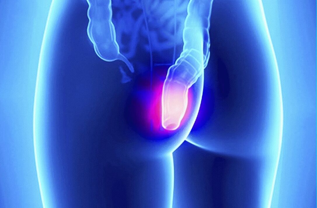 Gelarex je možné použiť zvonka aj rektálne